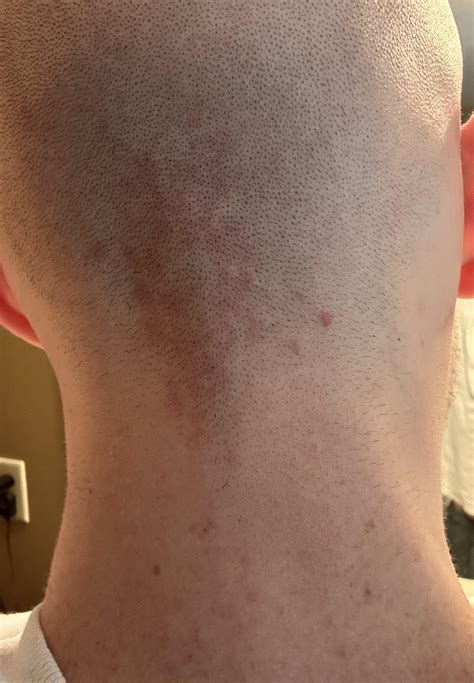 Persistent rash on back of neck : r/medical_advice