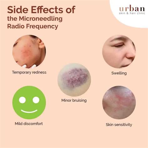 Microneedling Radio Frequency Treatment - Urban Skin and Hair Clinic