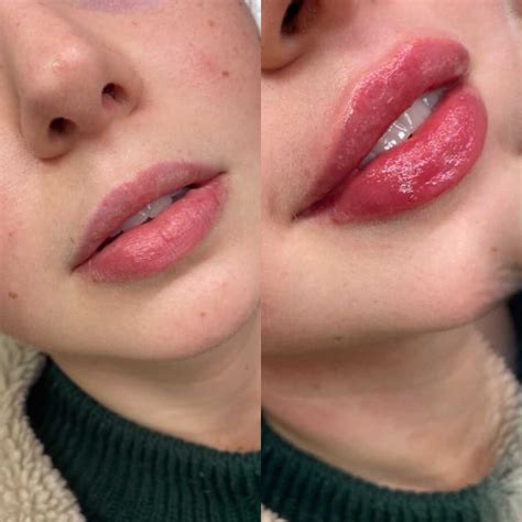 Lip filler before after – Artofit