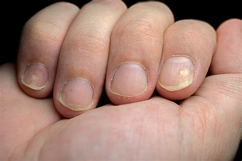 Why Are My Fingernails Getting White Spots at George Chavis blog