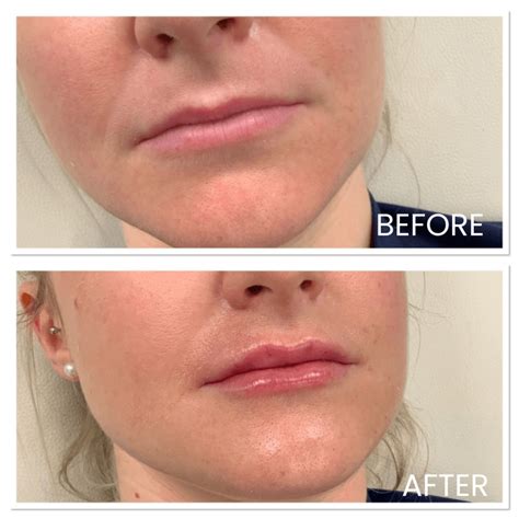 Lip Fillers: What it is, Types, Benefits & Side Effects - MySkyn