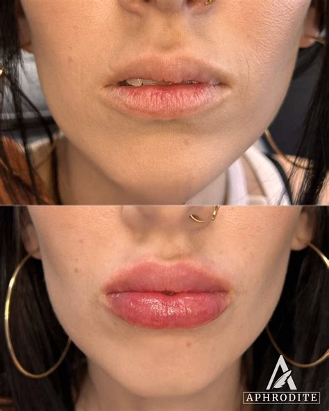 Before & After Lip Filler - Aphrodite Aesthetics & Wellness