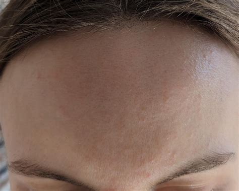 is this fungal acne? it’s all over my body (arms, shoulders, chest, back). More details in the ...