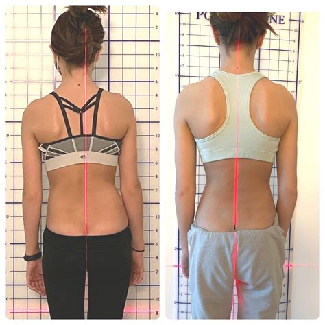 Scoliosis Before And After Yoga