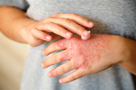 Is Eczema Contagious? | Langford Allergy