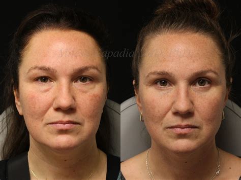 Before and 7 months after upper and lower blepharoplasty surgery with lower lid CO2 laser ...