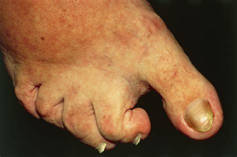 Long-Term Safety and Efficacy of Apremilast for Psoriatic Arthritis - Rheumatology Advisor