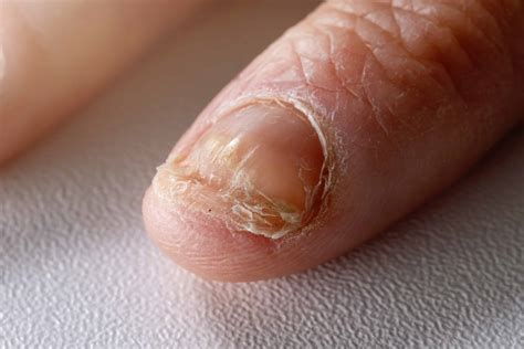 What Are the Causes of a Nail Bed Infection? | Spire Orthopaedic