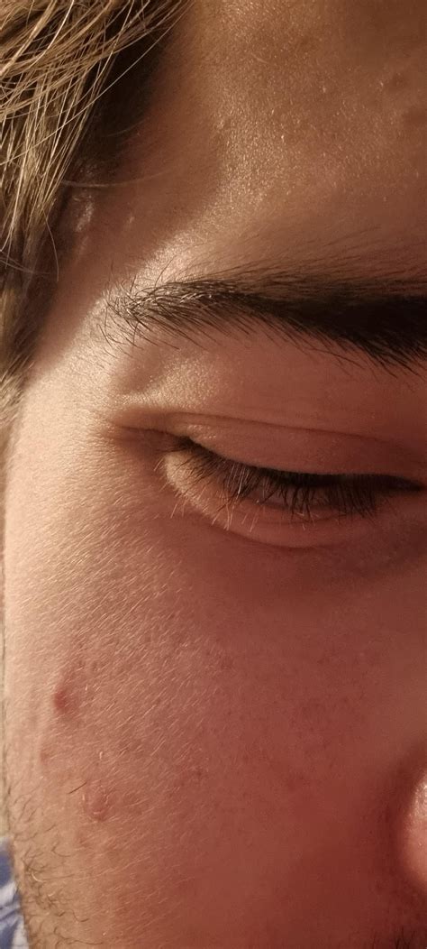 Why are my lower eyelids swelling? : r/Blepharitis