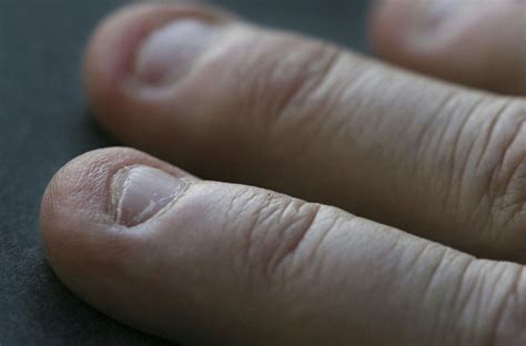 Skin Hanging Around Nail at Clinton Spears blog