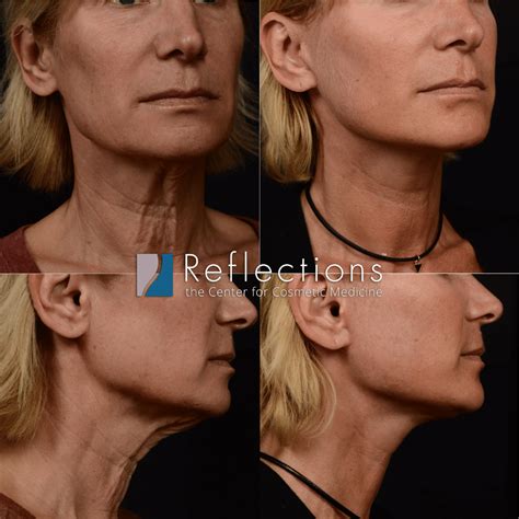 Double Chin / Sagging Under Chin New Jersey - Reflections Center