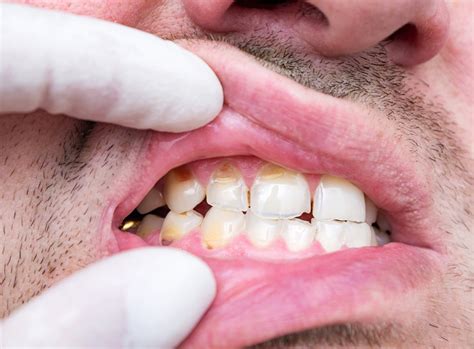 How to strengthen and protect your enamel?