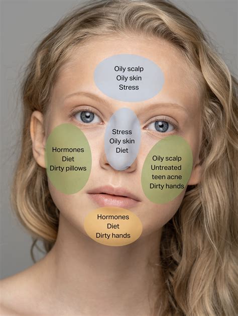 Stress Acne On Face