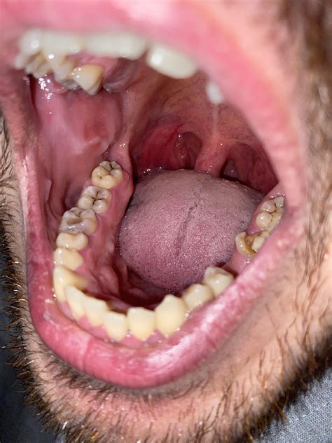 Any idea what these bumps/white spots could be in my mouth?The bumps appeared about a month ago ...