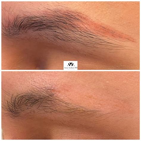 The Benefits Of Using Picosure Laser To Remove Microbladed Eyebrows