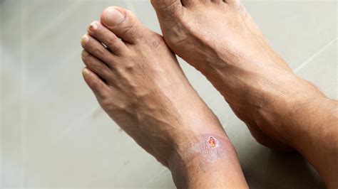 What Causes Pressure Sores On Feet at Lily Nava blog