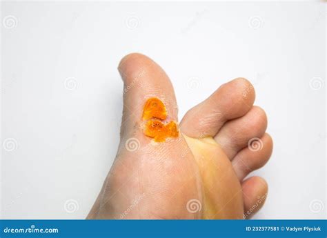 Plantar Wart Close Up On The Bottom Of A Female Foot Heel Caused By The Human Papillomavirus, Or ...