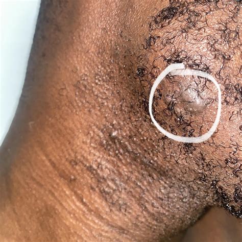 Ingrown Hair On Balls