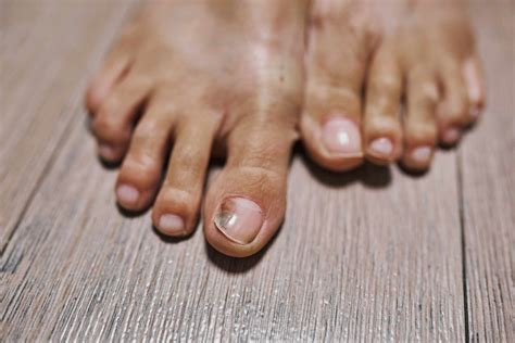 Black Toenail: Causes, Pictures, Treatment, & More