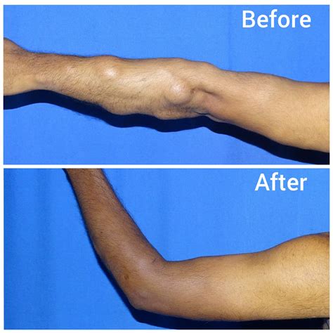 Lipoma Removal Bangladesh Cost, Prices, Before And After Photos – BYAMJ