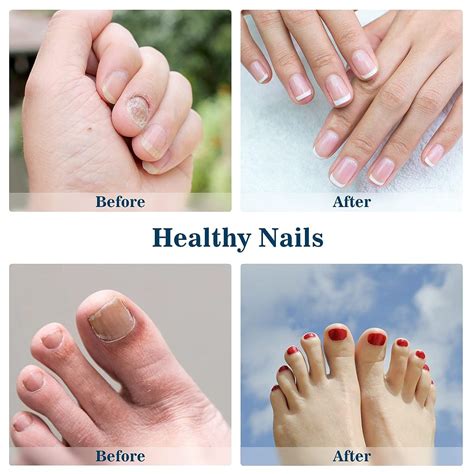 Onychom Laser Nail Treatment - Advanced Nail Fungus Laser Device for Thickened, Discolored ...