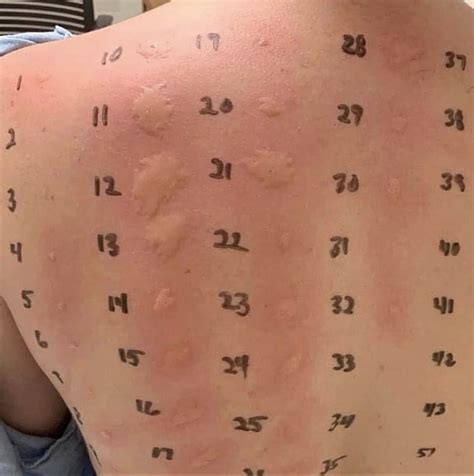 Skin tests for allergies! : r/medizzy