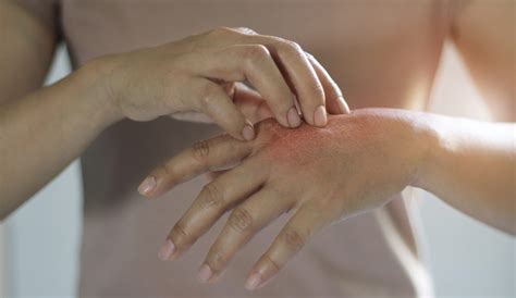 Dry Skin - National Menopause Foundation