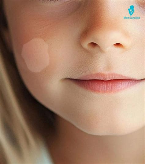 Pityriasis Alba Baby