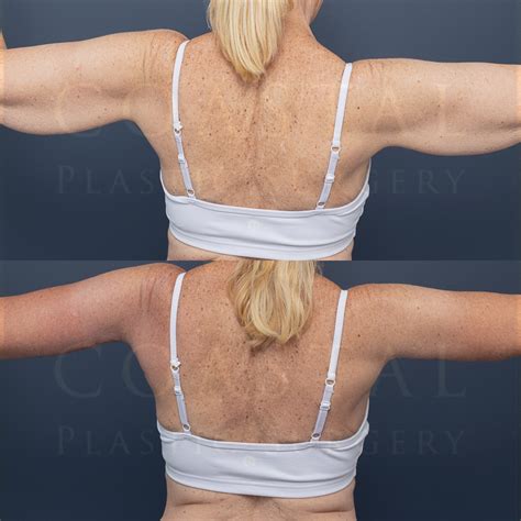Brachioplasty Gallery | Coastal Plastic Surgery | Sydney