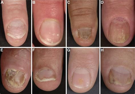 Psoriasis On Nails Images
