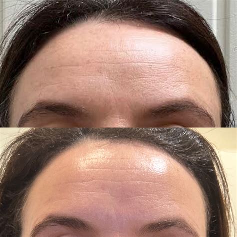 Dehydration & fine lines - Harmony Skin