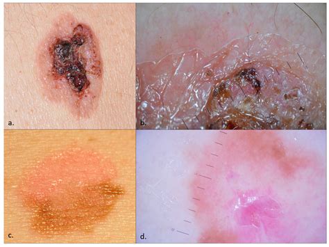 Erythroplasia Of Queyrat