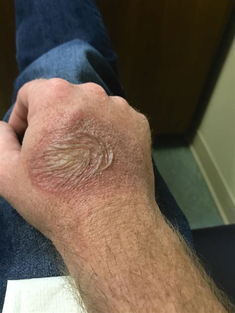 Popped Blister