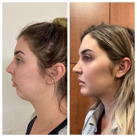 Before vs 6 weeks post op! I had double jaw surgery (not sure the exact ...