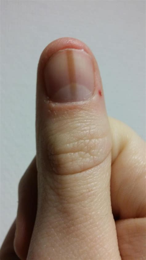 My thumbnail has a brown spot which grows with the nail. I've had it my entire life ...