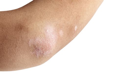 How To Treat Itchy Rash On Elbow at Georgia Challis blog