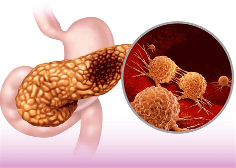 Laparoscopic Whipple Procedure: Treatment for Pancreatic Cancer