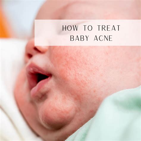 How To Treat Baby Acne - Skin Harmonics