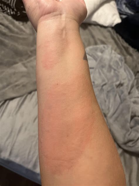 Cold urticaria : r/urticaria