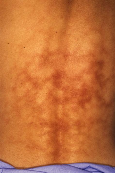 What Is Toasted Skin Syndrome?
