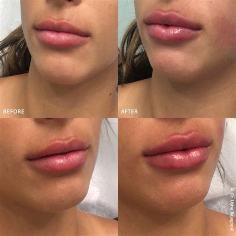 Lip Filler Before and After: Pictures and Comprehensive Guide