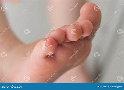 Enterovirus Leg Arm Mouth Skin Peeled Off On The Body Of A Child ...