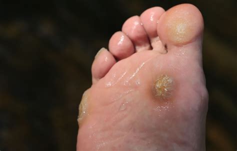 How Does Corn Appear On Foot Hotsell | emergencydentistry.com