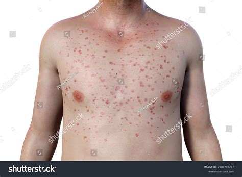Cold Virus Rash On Chest at Sarah Dobell blog