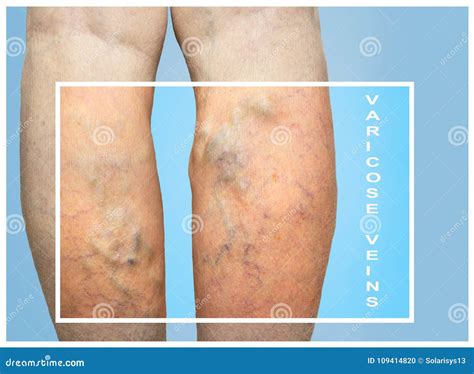 Varices En Piernas Femeninas Foto de archivo - Imagen de gente, agrandado: 109414820