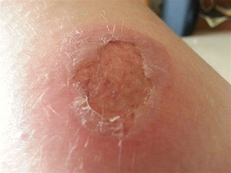 2nd Degree Burn Healed