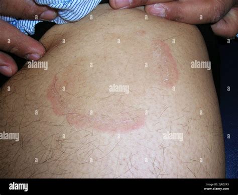 Erythema annulare centrifugum Stock Photo - Alamy