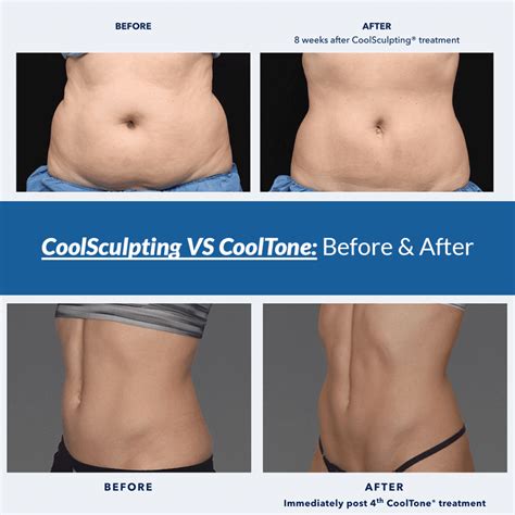 CoolSculpting VS CoolTone: Which Is Best For You? - The Derm | Dermatologists in Cook County, IL
