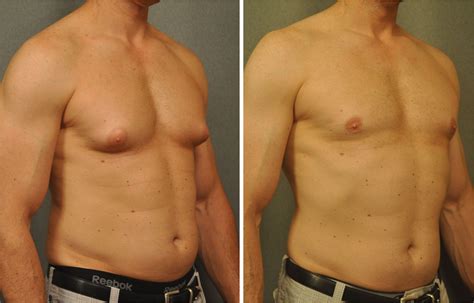 Chest Fat After Gynecomastia Surgery at Pauline Dane blog