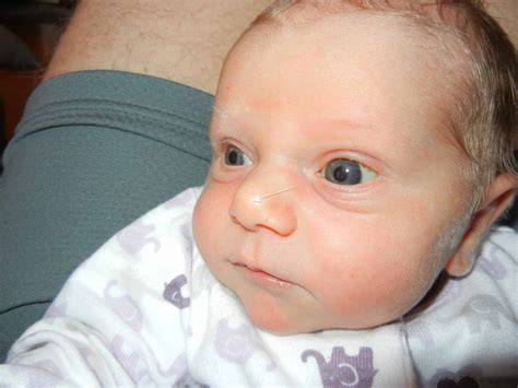 Newborn Skin Mottling